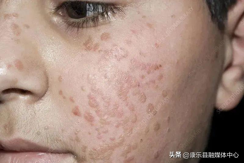 身上长了HPV，我们该如何面对与处理