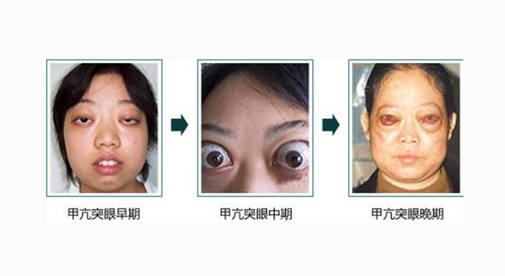 聊聊甲亢，深入了解甲状腺功能亢进