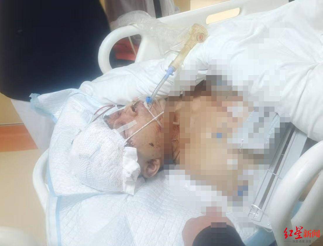 惊魂瞬间！男子遭遇三百斤野猪袭击，头骨受损在ICU紧急抢救