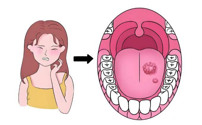 口腔溃疡会感染HPV病毒吗？解析口腔健康与HPV病毒的关系