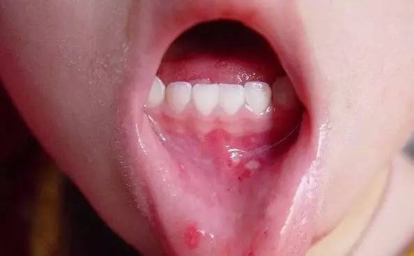 口腔溃疡是HPV病毒引起的吗？解析口腔溃疡与HPV病毒的关系