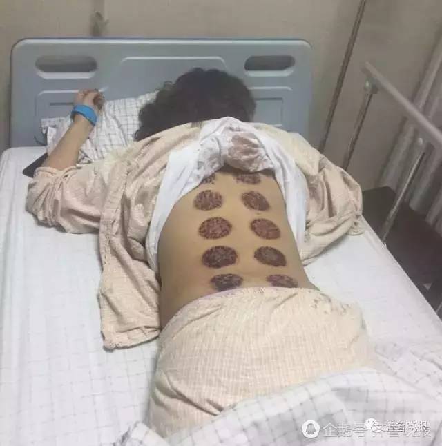 拔火罐死亡事件，深度探究与反思