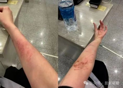 贵州遭遇极端天气，女演员拍戏受伤，逆境中的坚韧与力量