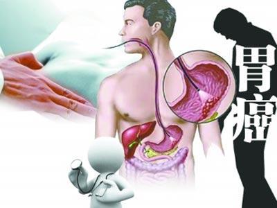 胃癌如何预防，从日常细节做起，守护你的胃健康